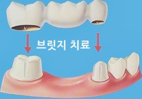 브릿지치료