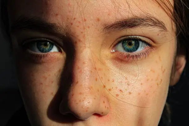 기미 없애는 방법