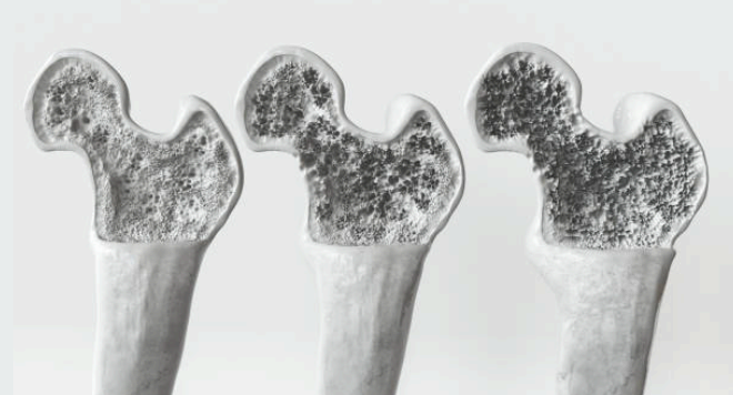 골다공증 이미지사진