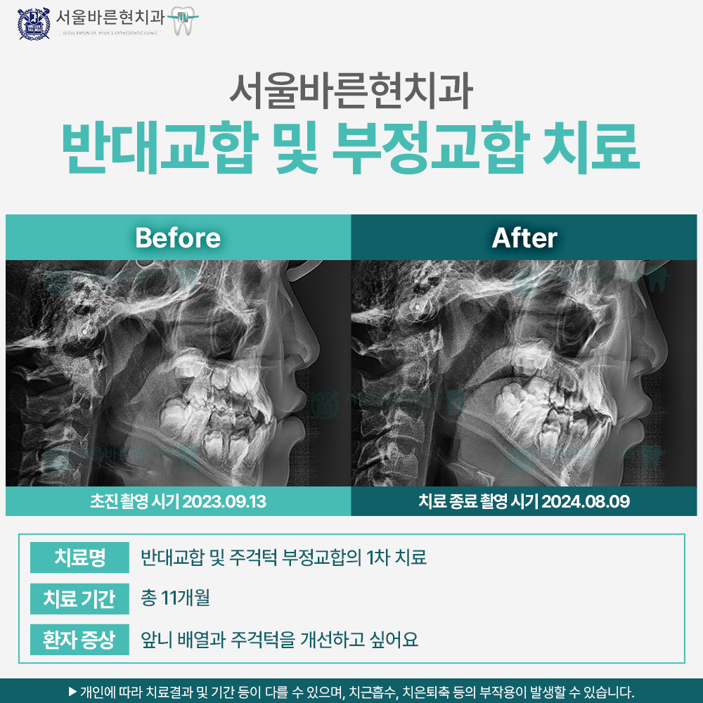 부산치아교정