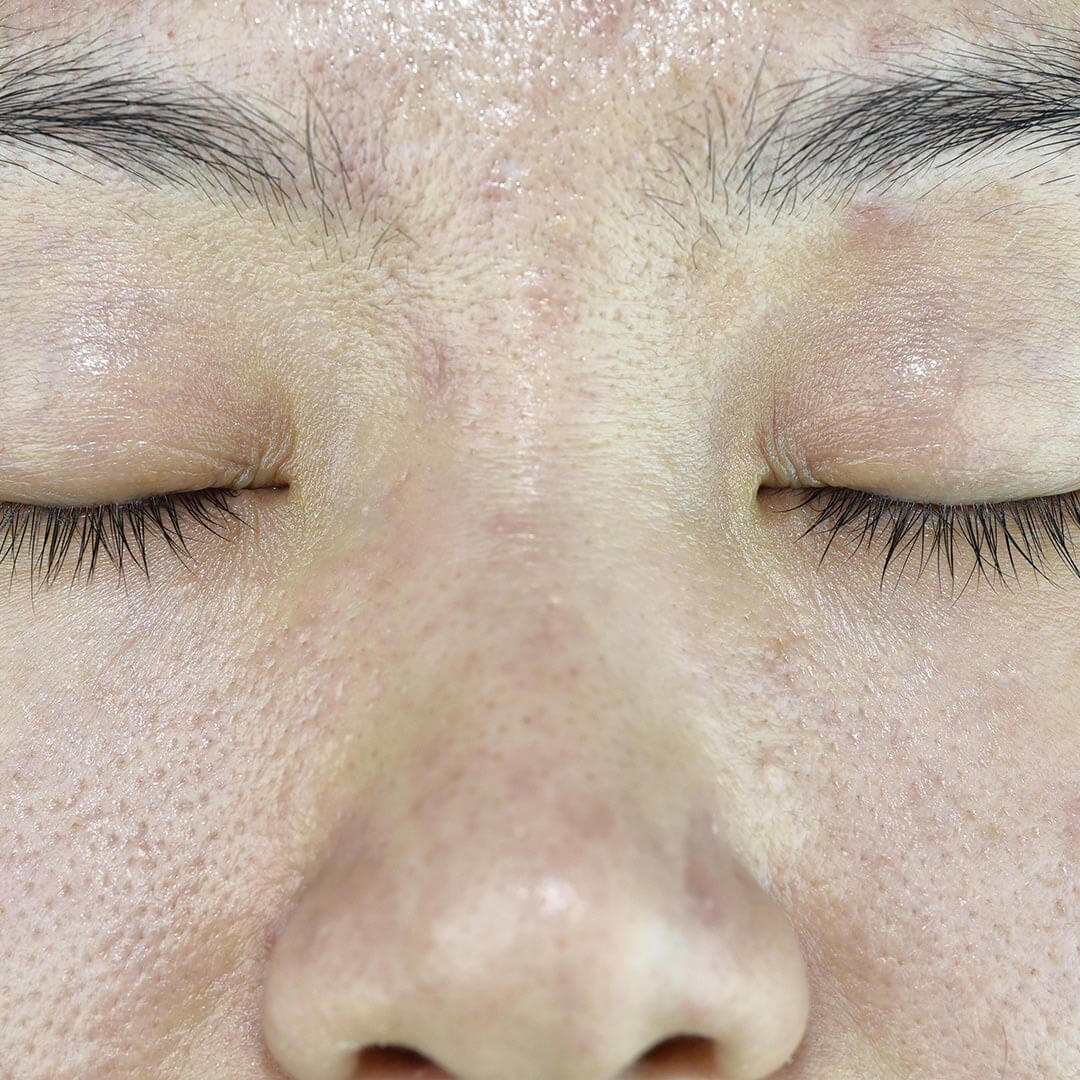 미간 피지 관리와 올바른 세안 방법을 설명하는 스킨케어 정보 이미지로 T존 부위의 피지 분비 원인과 효과적인 클렌징 순서를 안내하는 피부 관리 그래픽