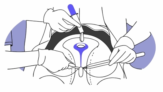 자궁근종 수술 과정