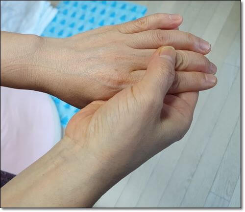 방아쇠수지증후군 치료