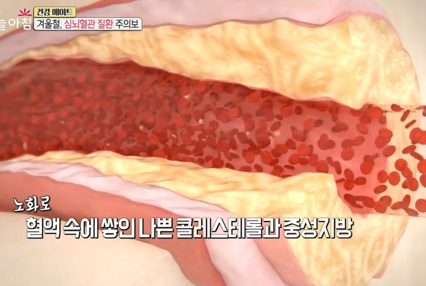 EBS-명의-심뇌혈관질환-오성진-교수