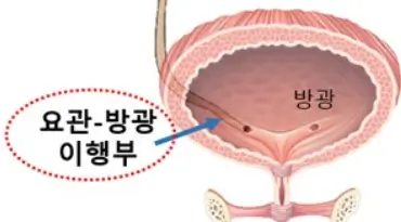 요관-방광 이행부- 위치