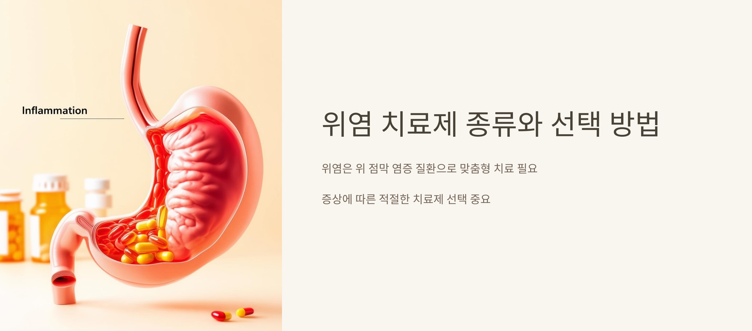 위염은 위 점막 염증 질환으로 맞춤형 치료가 필요하다는 이미지