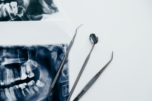 치아 엑스레이 사진