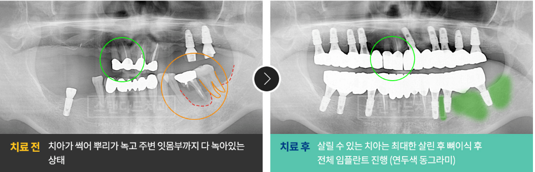 송파구-임플란트잘하는곳-자기치아살리기