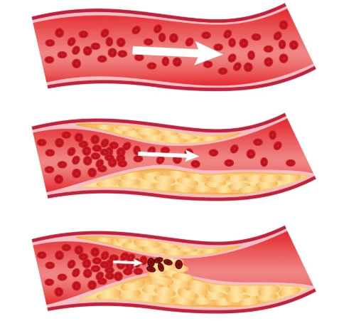 동맥경화증 초기증상