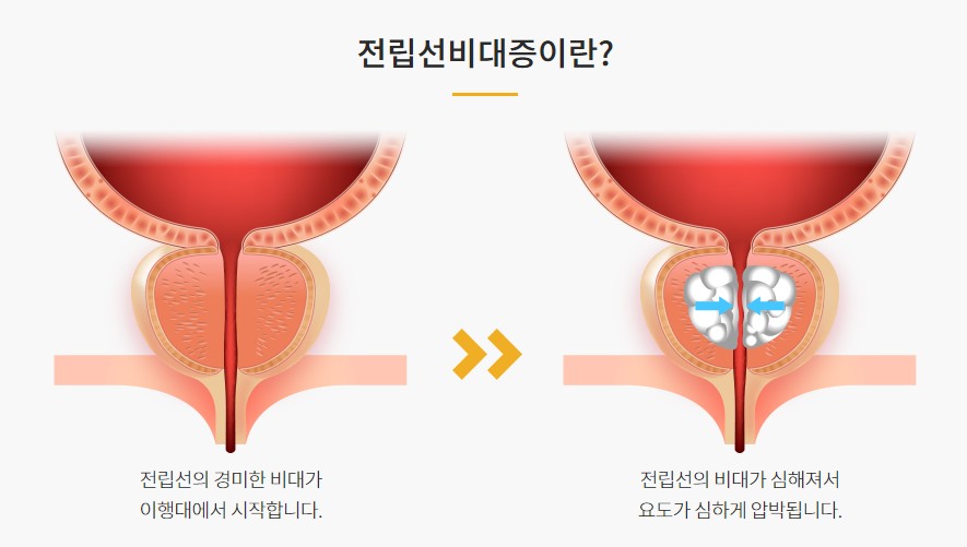 전립선비대증 초기치료