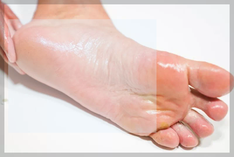 각질형무좀 치료