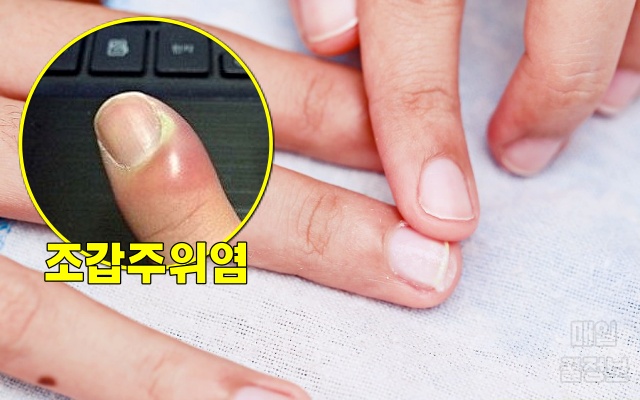 손톱 주변 살, 까시래기 거스러미, 손톱 주위 피부가 일어나는 경우, 손톱 옆 갈라짐 염증, 건강 팁줌 매일꿀정보
