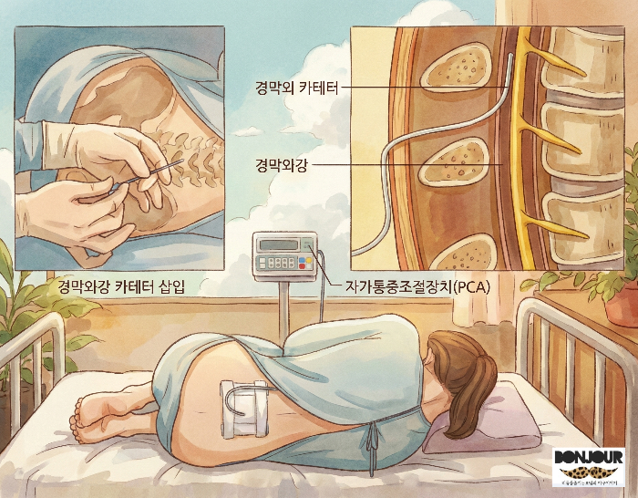 무통주사 원리 표현 이미지