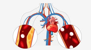 콜레스테롤 낮추는 방법 10가지