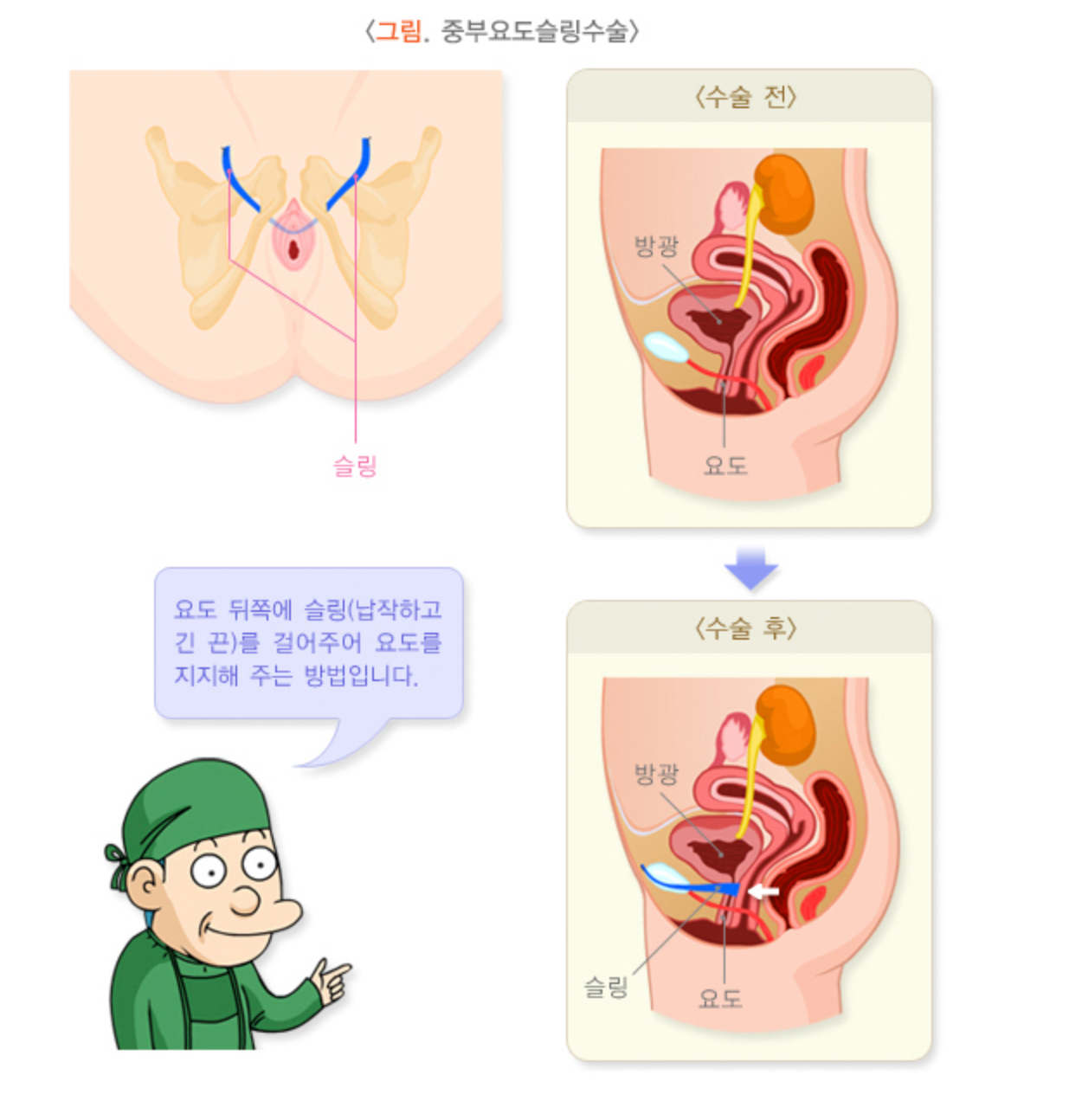 요실금 증상 치료방법 수술 비용