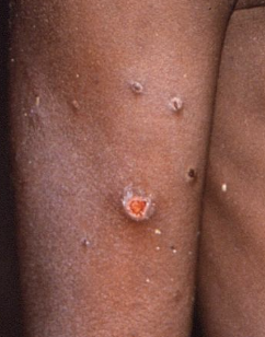 mpox