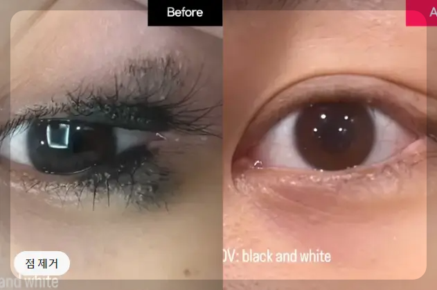 키싱점 제거 전과 후