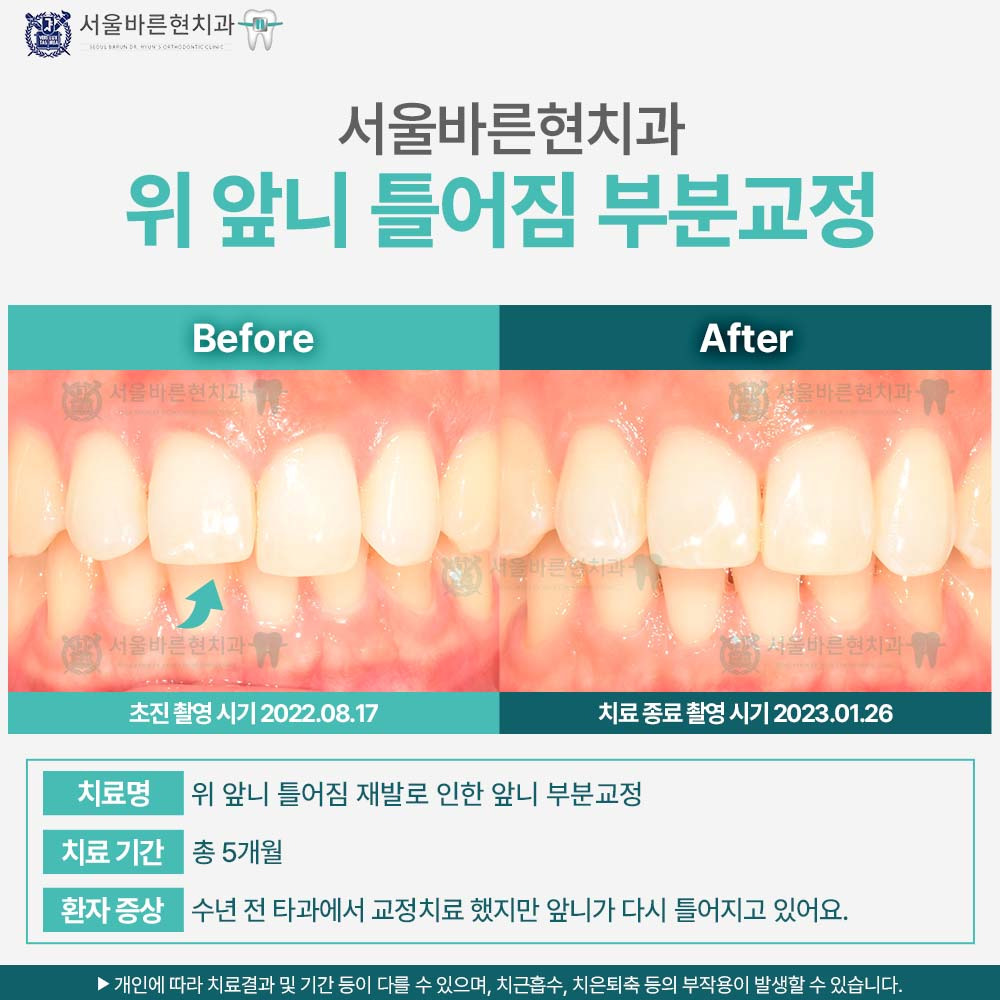 해운대부분교정
