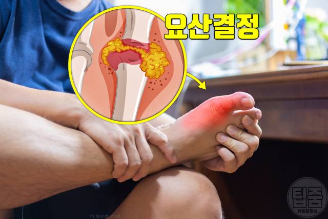 통풍 초기증상 엄지발가락 통증 원인 통풍 증상