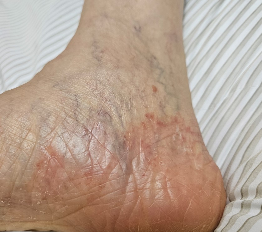 60대 70대 무좀