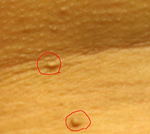 쥐젖(연성섬유종)