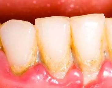 치과 정기 검진으로 치석제거하기