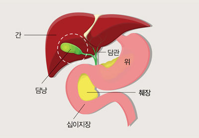 쓸개(담낭) 제거수술