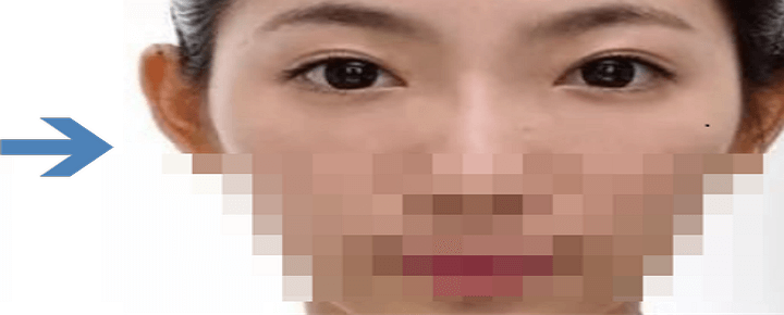 눈밑지방제거 후 사진