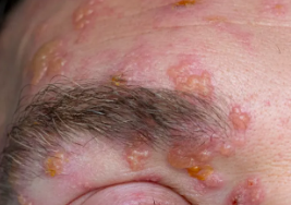 아시클로버 연고 효능