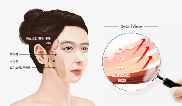 덴서티 리프팅 댄서티 가격 효과 유지기간에 관한 정보_7