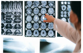 뇌졸증 원인, 증상, 치료, 예방, 질병코드 : 갑자기 찾아오는 불청객