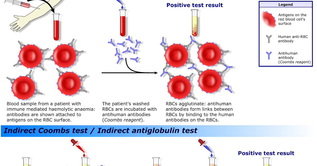 자가면역 용혈성 빈혈에서 Coombs 검사의 역할과 한계