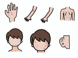 피부발진의 종류