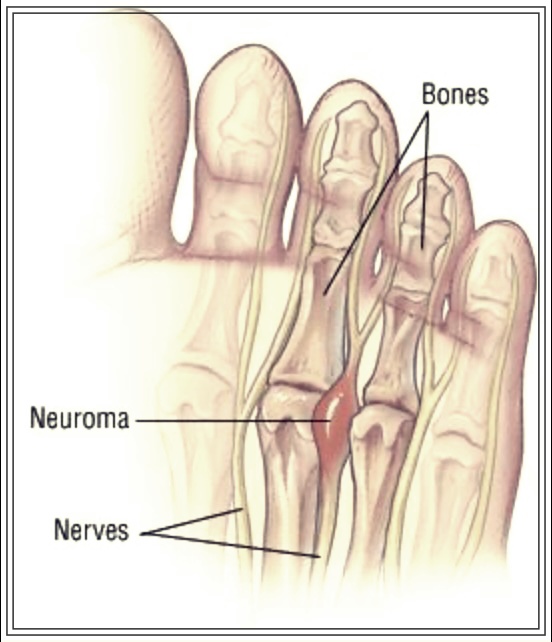 발바닥 고통, 그 원인은? 지간신경종의 정체와 치료법.