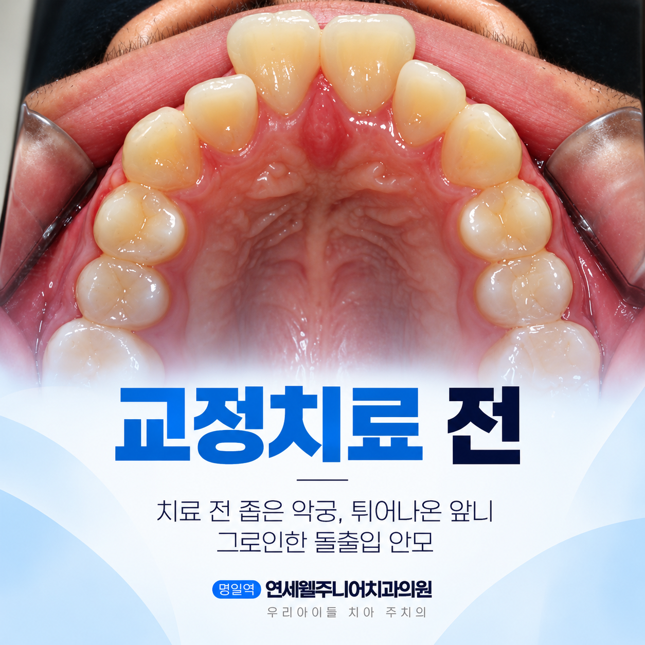 중학생 치아교정 전 좁은 위턱 악궁과 불규칙하게 배열된 앞니의 구강 내부 사진