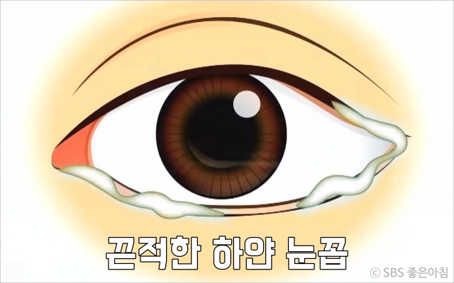 끈적한 하얀 눈곱이 끼는 이유 눈질환 유행성결막염 증상 전염 눈병 충혈,건강 팁줌 매일꿀정보
