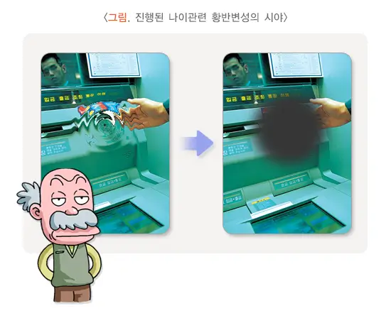 황반변성 자가 테스트, 원인 종류 증상 예방 치료방법