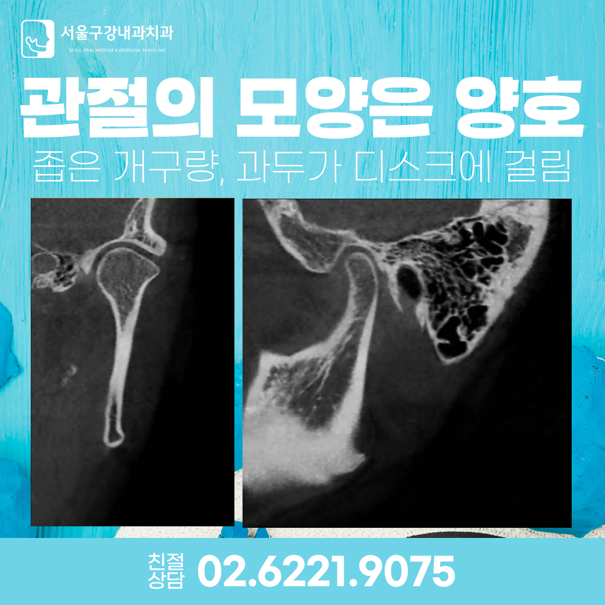 서울구강내과치과에서 턱관절 교착 해소를 위한 도수치료를 시행하는 모습, 개구제한 치료 과정 이미지