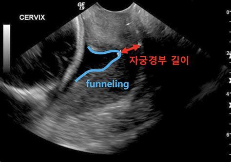 자궁경부조직검사