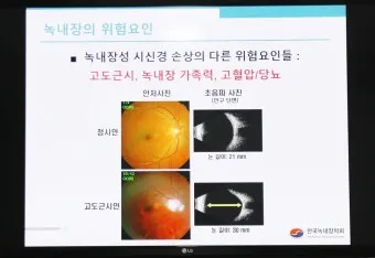 녹내장 진단 검사 비용 안압 검사주기 관리법_8