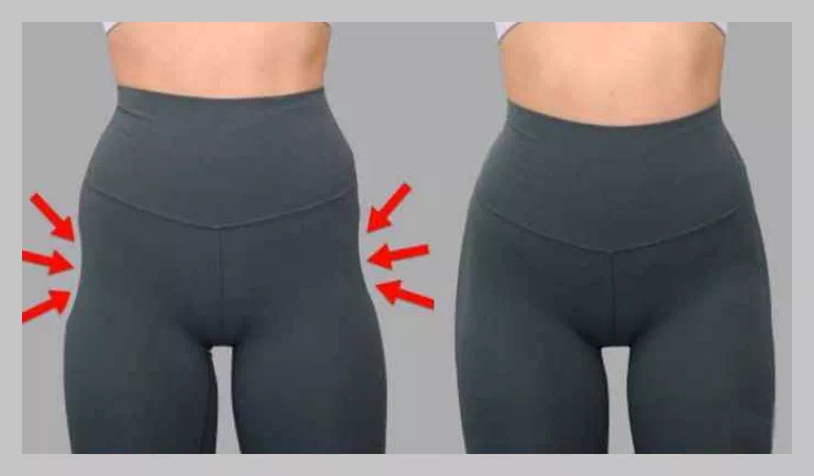 힙딥 필러 시술