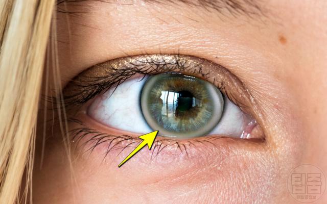 눈 흰고리 흰줄, 고지혈증,팁줌