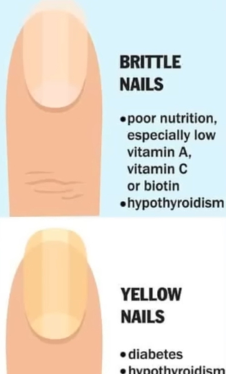 손톱에 세로줄이 생기는 이유