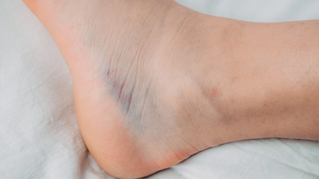 발목 접질렀을때