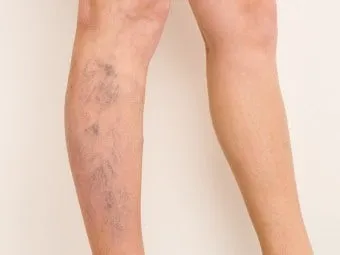 하지 정맥류 증상 치료방법과 예방 생활습관_2