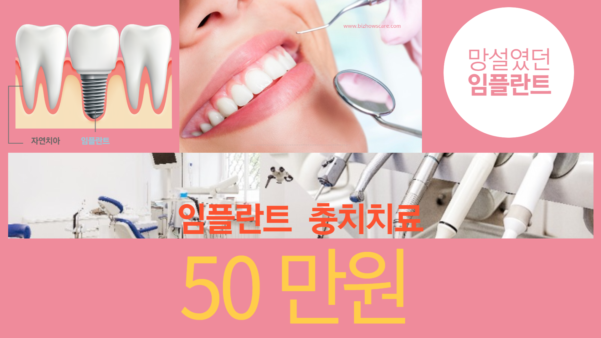 경제적인 금액 임플란트 50만원 최저가로 치료 받으세요
