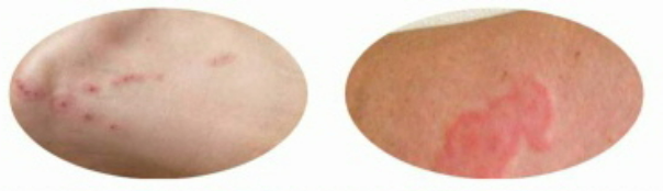 빈대 물림 증상