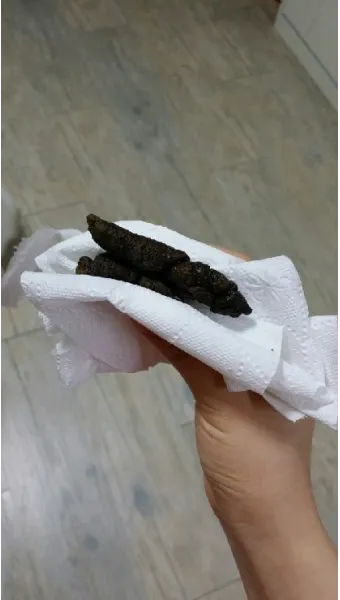 똥이 까만색 검정똥 원인과 질병 가능성_22