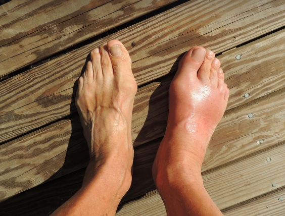 통풍이 일어난 발에 모습