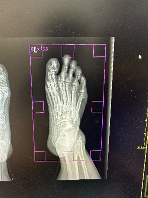환자의 흔들림에 의해 모션 아티팩트가 발생하여 나온 X-ray 엑스레이 영상 모습